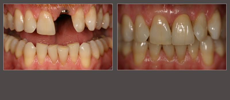 tooth implant